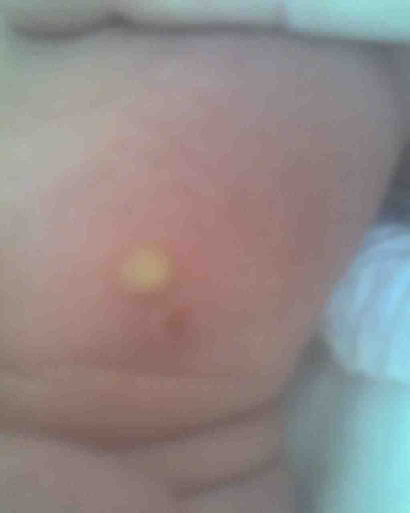 blister pimple
