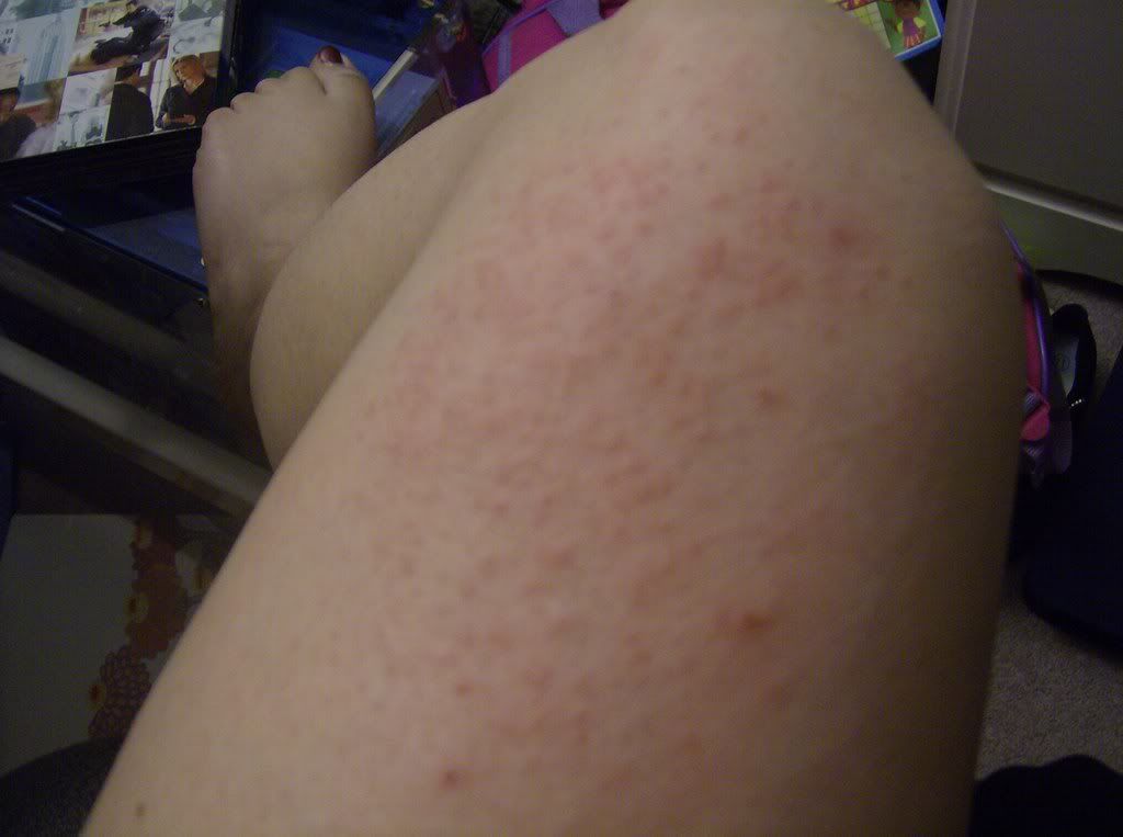 hive rash
